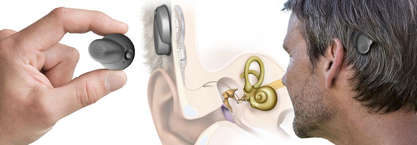 Les implants d'oreille moyenne